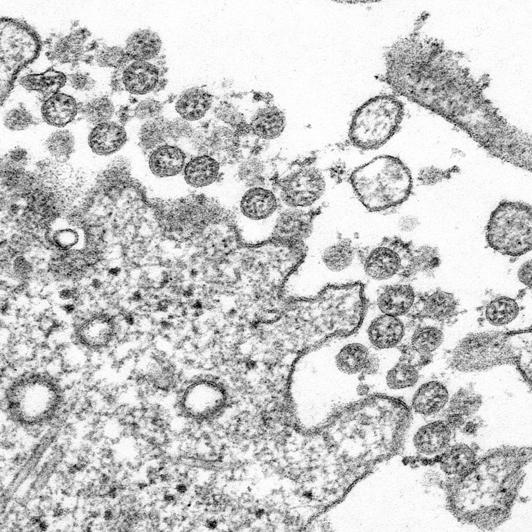 This is a transmission electron microscopic image of an isolate from the first U.S. case of the COVID-19 coronavirus, formerly known as 2019-nCoV. The spherical extracellular viral particles contain cross-sections through the viral genome, seen as black dots.
